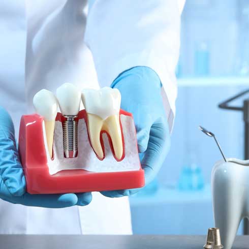 Dental-implants-Dr.-Mark-Rhody-Dentistry